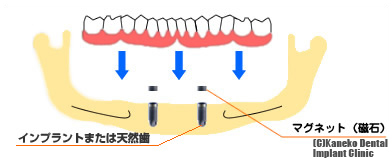 磁石式義歯