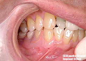 部分入れ歯のフレキシブル義歯