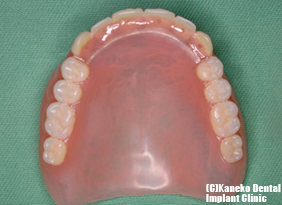 フレキシブル総義歯（上顎）