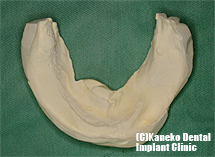 下顎の模型（硬い石膏）