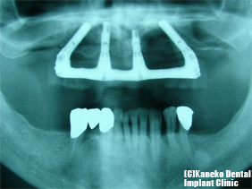 歯肉付きの上部構造