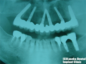 人工歯だけの上部構造